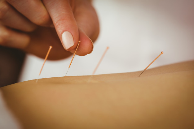 Acupuncture